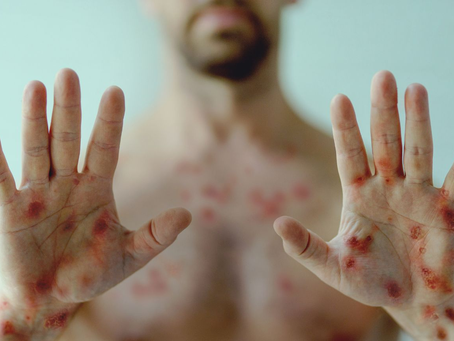 La OMS declara emergencia global por MPOX