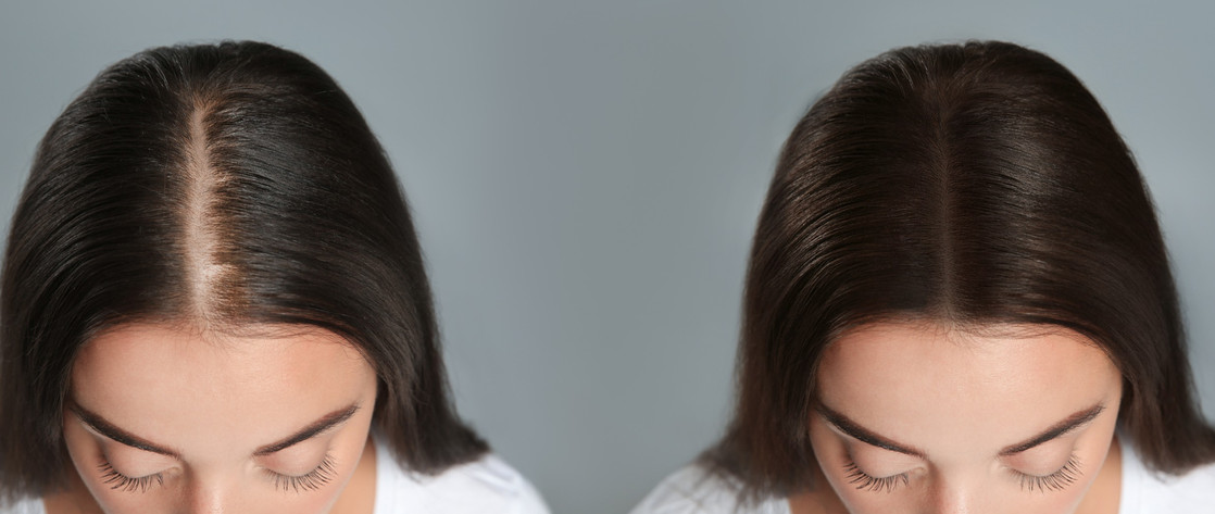 Perte de cheveux Laval | Centre Capillaire de L'Ouest