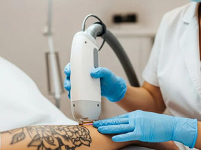 Understanding Laser Tattoo Removal Healing Process