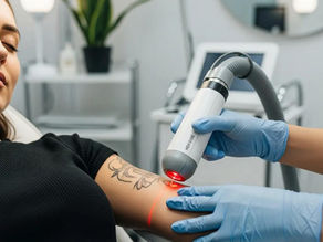 The Benefits of Non-Invasive Laser Tattoo Removal
