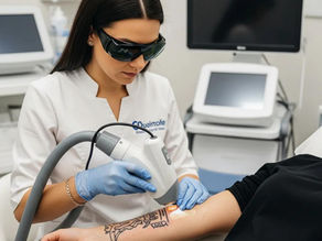 How Does Laser Tattoo Removal Work Effectively?