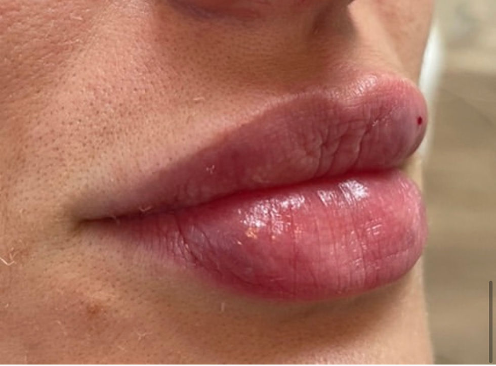 Visit Our Clinic In Horsham For Expert Lip Fillers