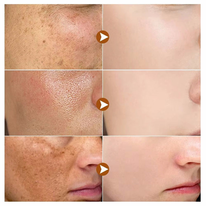 الصورة المصغرة: Dark Spots Remover Whitening Serum Face Freckle Melanin Correcting Reduce Fine L