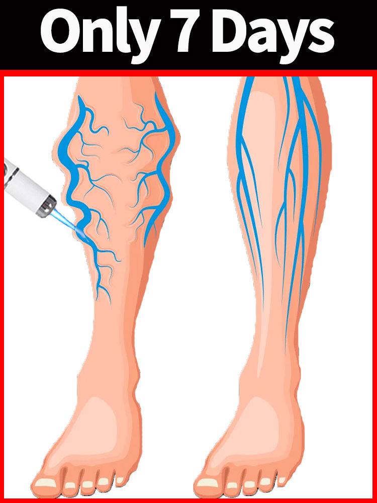 blue light pen solve varicose veins, hot sale leg care tools