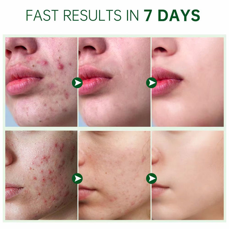 Thumbnail: Salicylic Acid Acne Treatment Face Serum Repair Pimple Spots Deep Cleaning Pore 