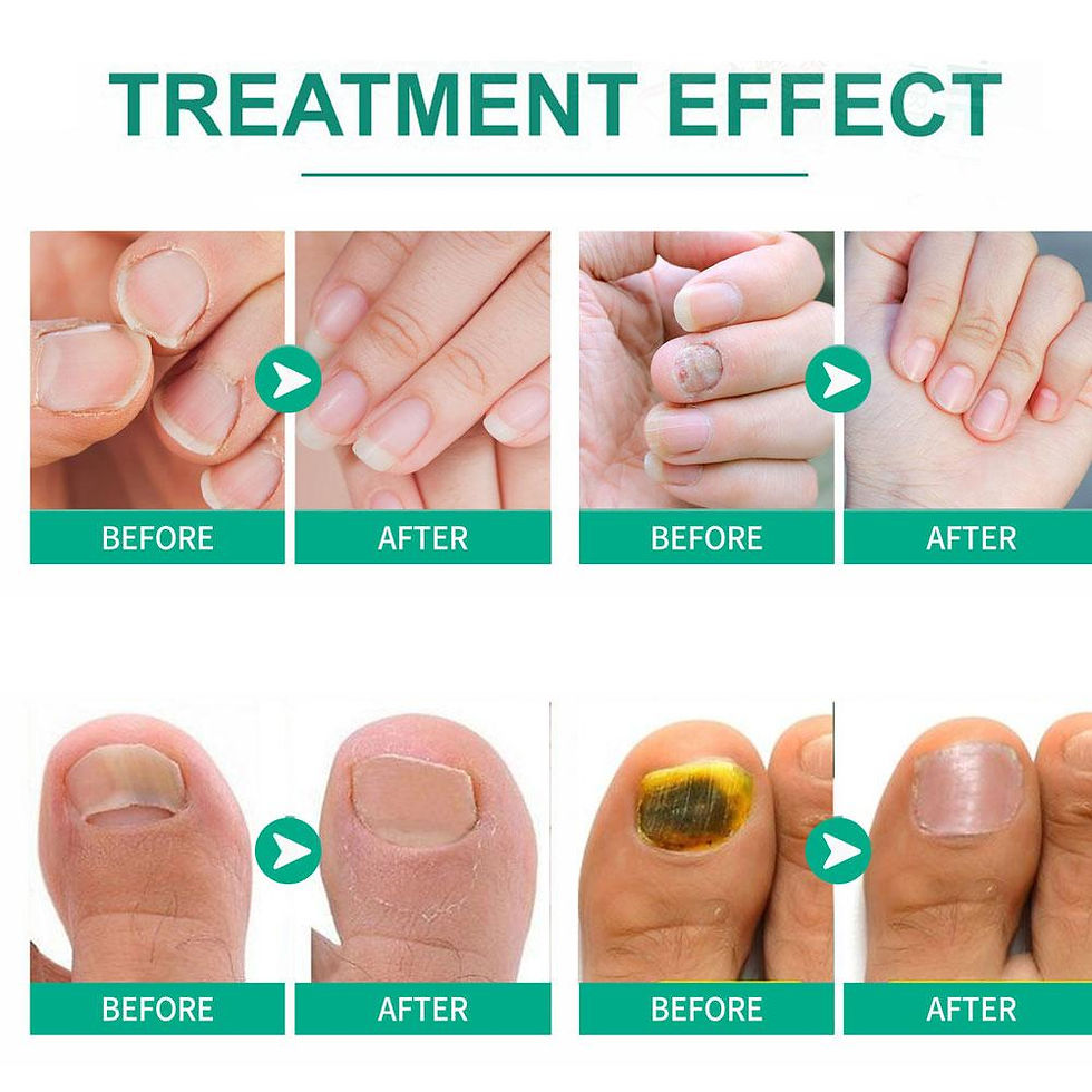 Thumbnail: Extra Strong Nail Fungus Treatment Serum Essence oil Care Repair Essence Anti To