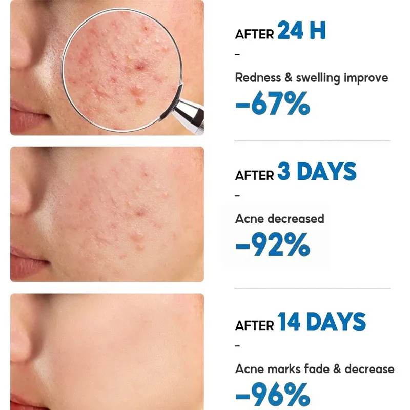 الصورة المصغرة: Salicylic Acid Acne Removal Cream Anti-Acne Repair Redness Pimple Spots Deep Cle