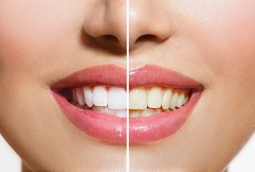 Isabellas+Clearly+GLOW+Before+and+After.