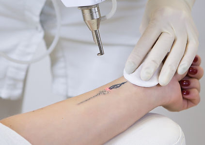 how-does-laser-tattoo-removal-work.jpeg
