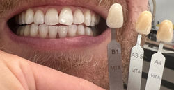 Combine bleaching PUREWHITENING