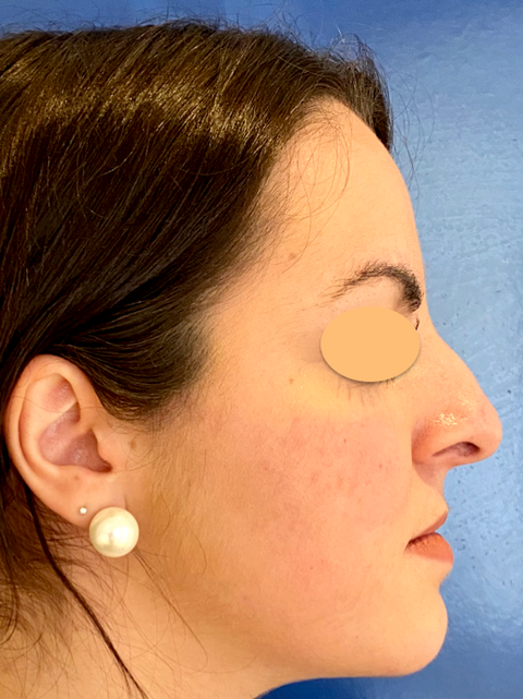 Avant après rhinoplastie