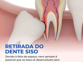 Exodontia do Siso