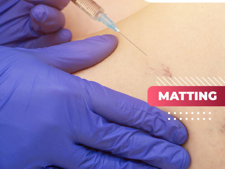 Matting | Clínica De Enfermedades Vasculares