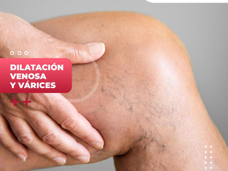 Dilatación Venosa Y Várices | Clínica De Enfermedades Vasculares