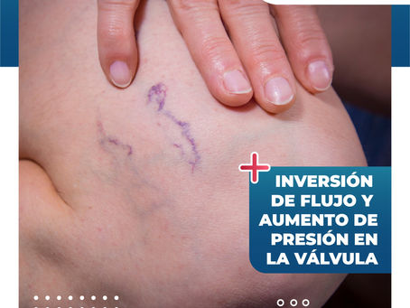 Inversión De Flujo Y Aumento De Presión En La Válvula | Clínica De Enfermedades Vasculares Y Heridas