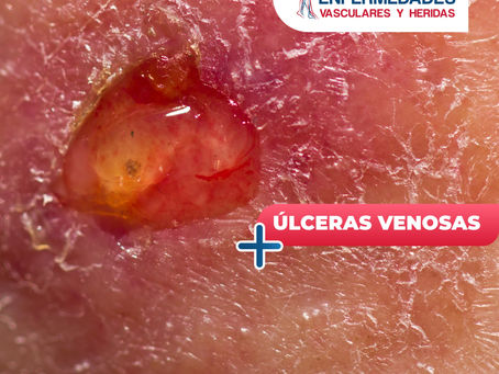 Úlceras Venosas | ClÃnica De Enfermedades Vasculares y Heridas