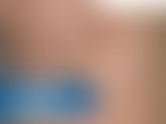 ¿Las Arañas Vasculares Tienen Relación Con Las Várices? - Clínica De Enfermedades Vascular