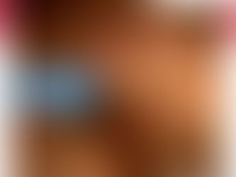 Microcirugía De Müller O Flebectomía | Clínica De Enfermedades Vasculares Y Heridas