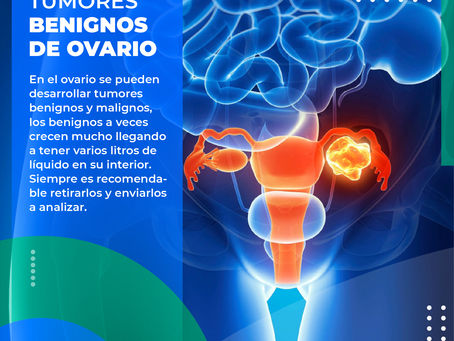 "Tumores Benignos De Ovario"/ Dr. Franco Krakaur/ Cirujano Oncólogo