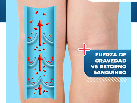 Fuerza De Gravedad Vs Retorno SanguÃneo | ClÃnica De Enfermedades Vasculares