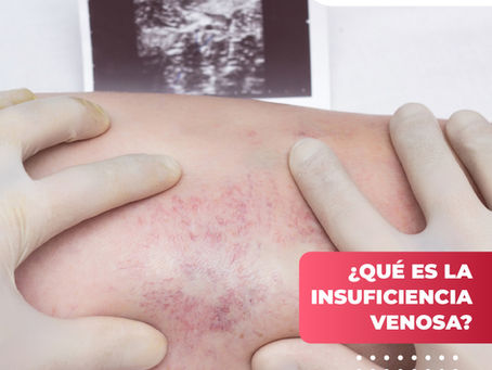 ¿Qué Es La Insuficiencia Venosa? | Clínica De Enfermedades Vasculares Y Heridas