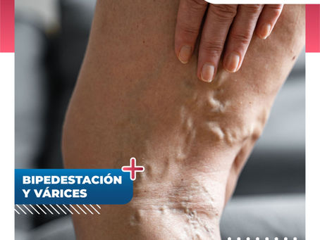 Bipedestación Y Várices | Clínica De Enfermedades Vasculares Y Heridas