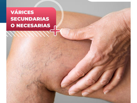 Várices Secundarias O Necesarias | Clínica De Enfermedades Vasculares