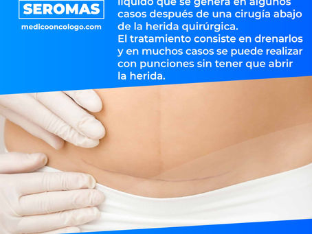 "Seromas"/ Dr. Franco Krakaur/ Cirujano OncólogoÂ