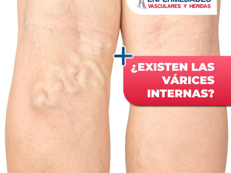 ¿Existen Las Várices Internas? - ClÃnica De Enfermedades Vascular Y De Heridas