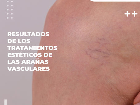 Resultados De Los Tratamientos Estéticos Arañas Vasculares- Clínica De Enfermedades Vascular