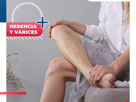 Herencia Y Várices | ClÃnica De Enfermedades Vasculares Y Heridas