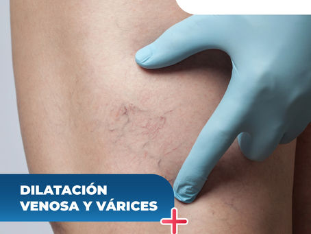 Dilatación Venosa Y Várices - ClÃnica De Enfermedades Vascular Y De Heridas