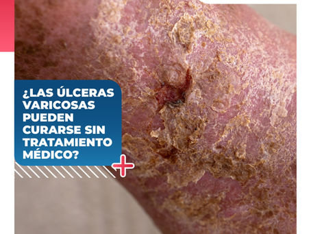¿Las Úlceras Se Pueden Curar Sin Tratamiento? | ClÃnica De Enfermedades Vasculares y Heridas