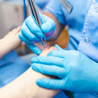 Ingrown nails may develop for many reasons. Some cases are congenital—the nail is just too large for the toe. Trauma, such as stubbing the toe or having the toe stepped on, may also cause an ingrown nail. Our healthcare providers will diagnose an ingrown toenail by inspecting it. They’ll examine the skin at the edge of the nail and determine the treatment plans suitable.