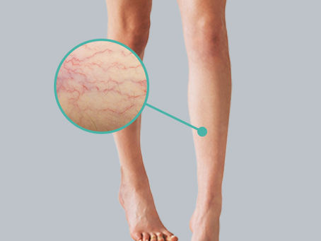 PEIM: O Tratamento Eficiente para Secamento de Microvasos