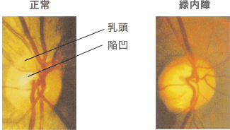 むさしこやま眼科　緑内障