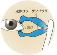 むさしこやま眼科 ドライアイ コラーゲンプラグ