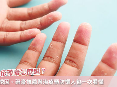 汗皰疹藥膏怎麼選？常見誘因、藥膏推薦與治療預防懶人包一次看懂