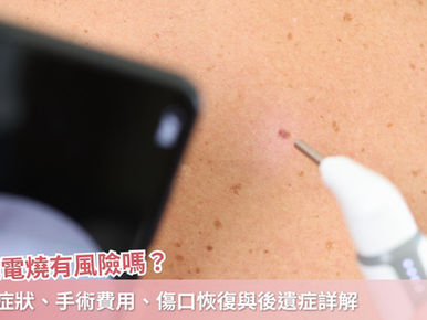 菜花電燒有風險嗎？初期症狀、手術費用、傷口恢復與後遺症詳解