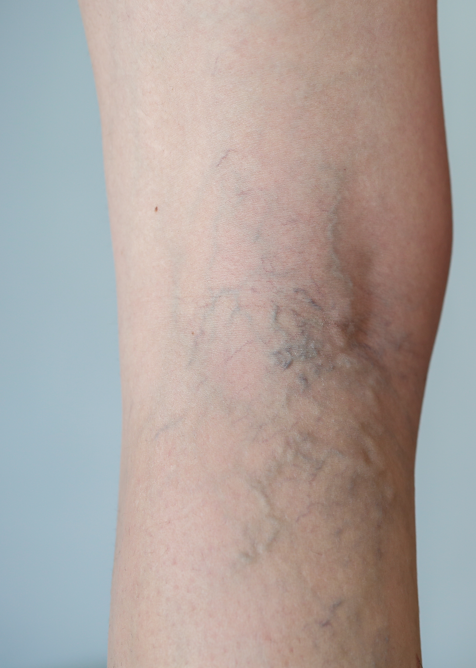 Varicose Veins (Before Treatment)