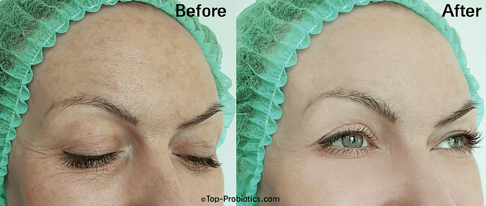 Thumbnail: Facial Bleaching Before and after | Lidya