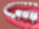 What is the Process for Getting a Dental Implant