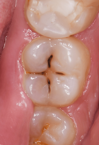 Early tooth loss in children