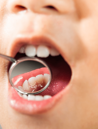 Early tooth loss in children