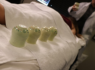 Cupping is another method of Chinese Medicine and natural healing