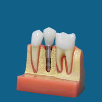 What is Bone Grafting?