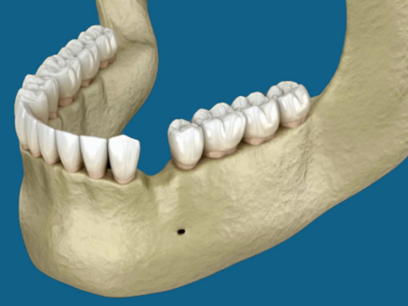 What is a Ridge Augmentation?