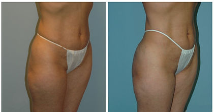 NJ Liposuction Plastic Surgeon