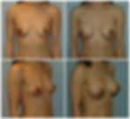 BREAST AUGMENTATION