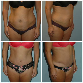 Abdominoplasty Tummy Tuck NJ Before After`